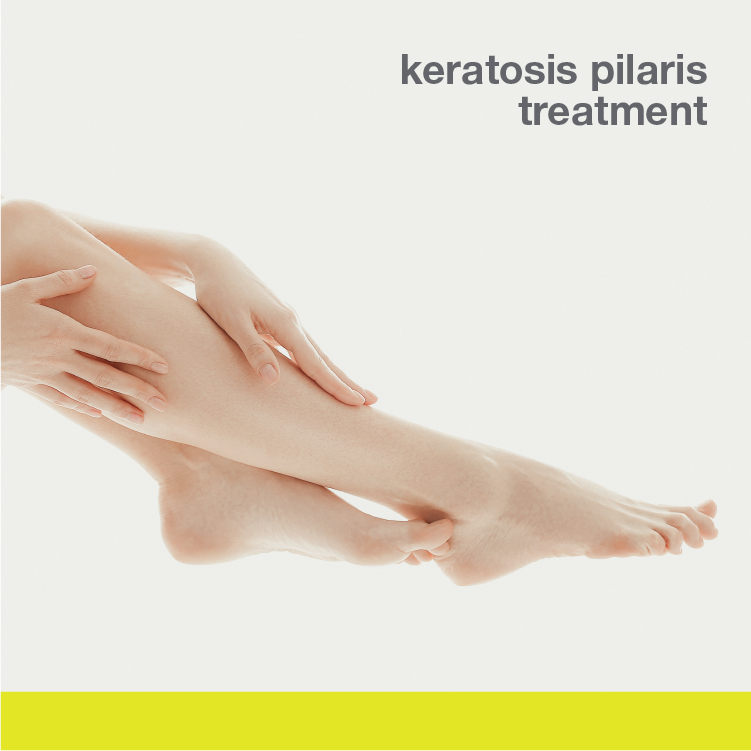 Keratosis Pilaris