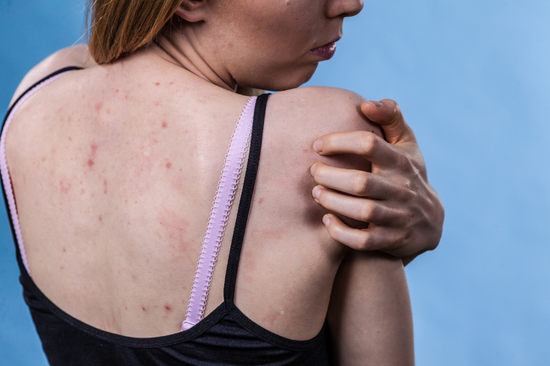 Keratosis Pilaris - All You Need to Know