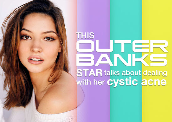This ‘Outer Banks’ star talks about dealing with her cystic acne
