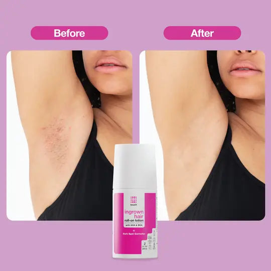 Ingrown Hair Rollon Before and after
