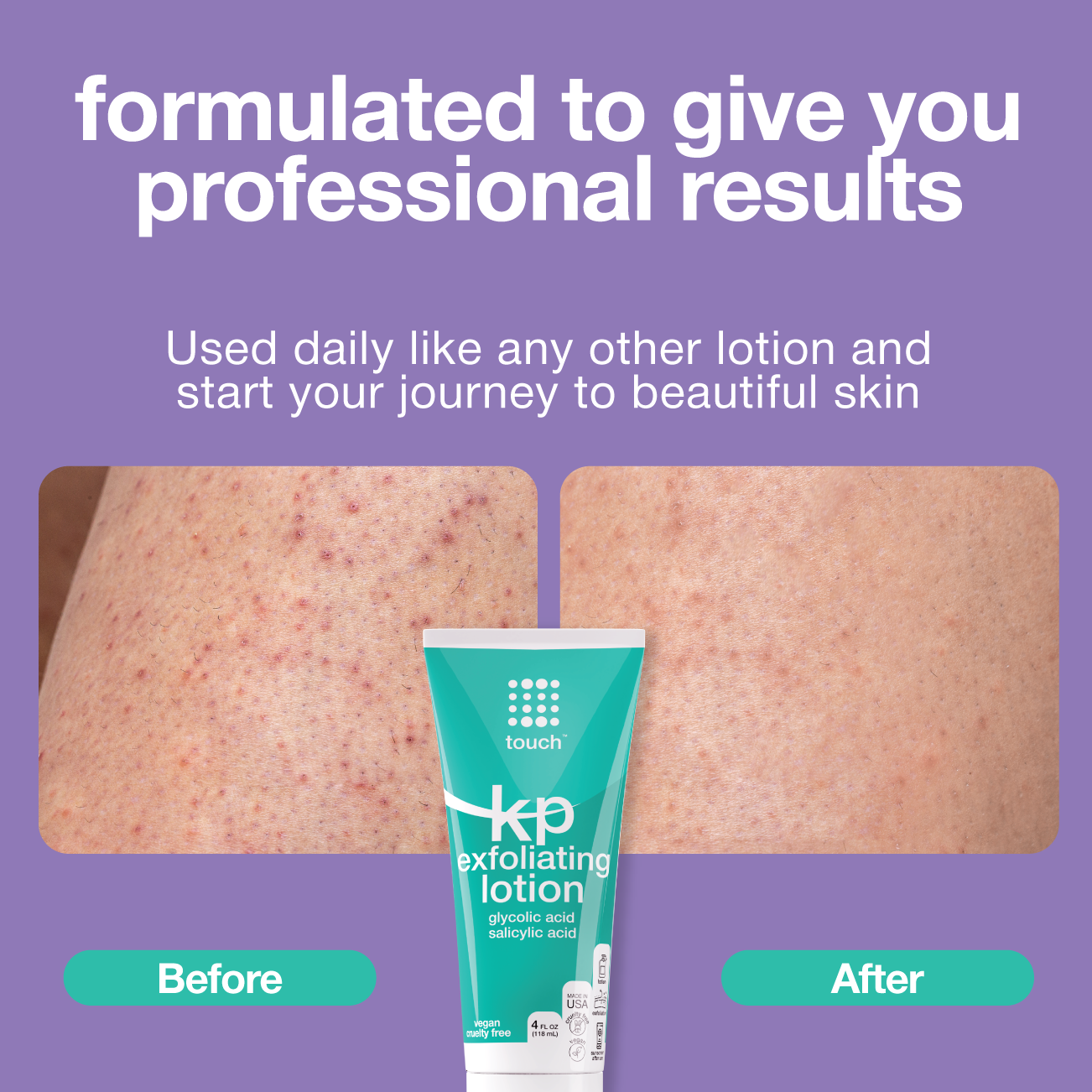 Keratosis Pilaris with 12% Glycolic Acid & 2% Salicylic Acid Exfoliating Lotion - 4oz