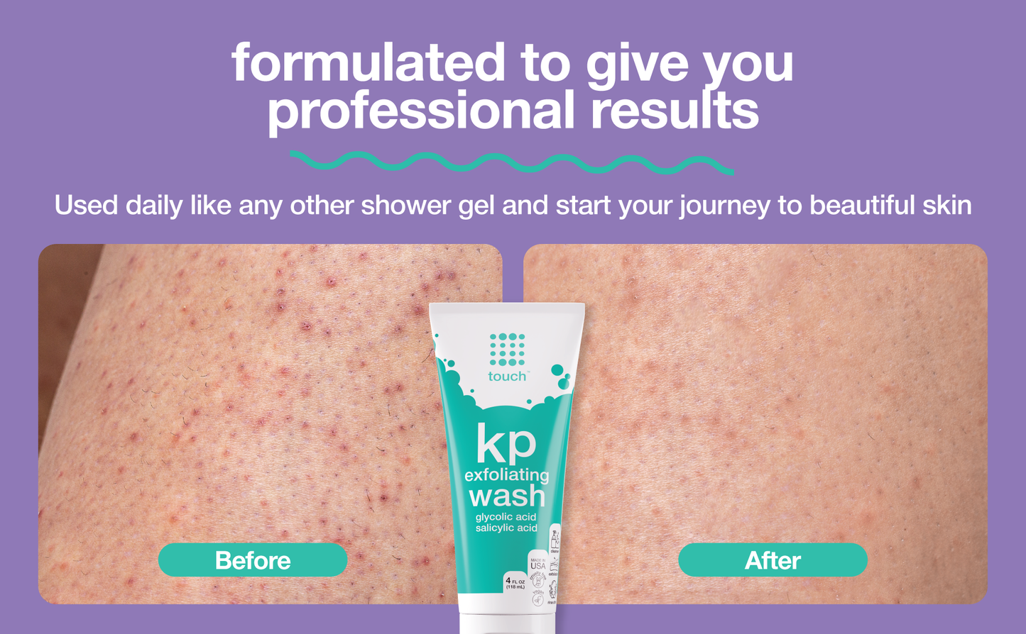 Keratosis Pilaris Exfoliating Body Wash with 15% Glycolic Acid, 2% Salicylic Acid - 4oz