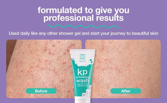 Keratosis Pilaris Exfoliating Body Wash with 15% Glycolic Acid, 2% Salicylic Acid - 4oz